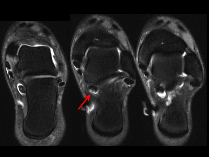 Figure 2 for case FHL partial tear and tenosynovitis